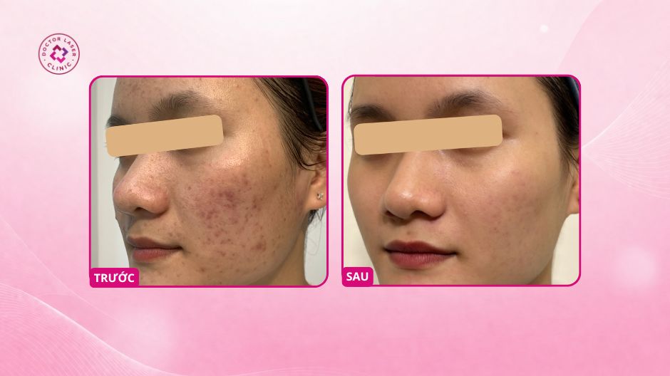 kết quả mụn ẩn và thâm sau mụn sau 6 tháng điều trị