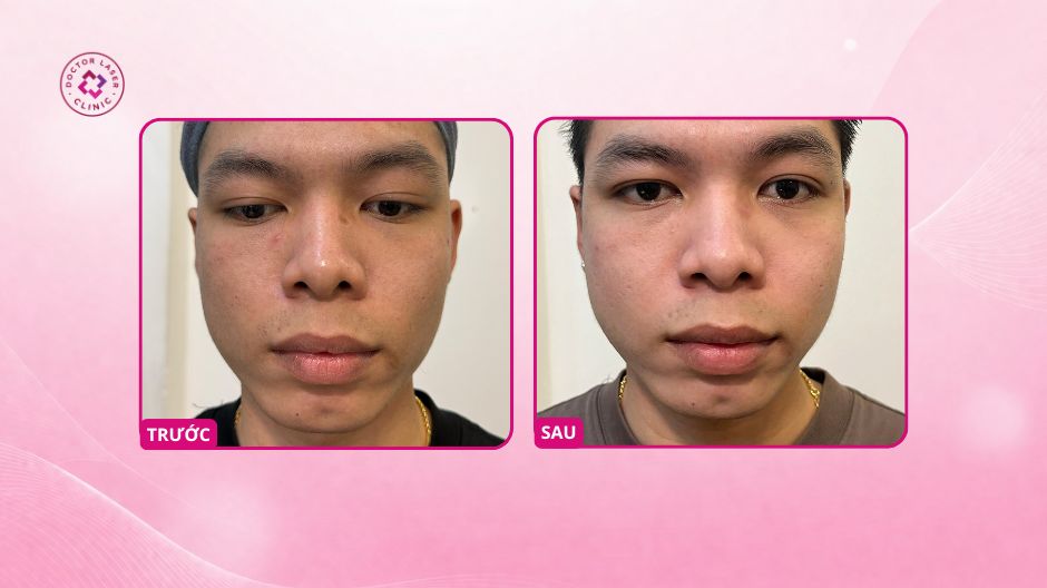 kết quả sẹo lõm vùng mũi sau 4 buổi điều trị