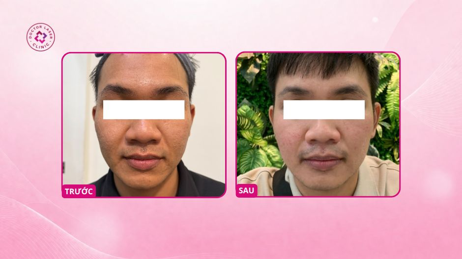 kết quả sẹo rỗ sau 2 lần điều trị