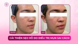 khắc phục sẹo rỗ do điều trị mụn không đúng cách