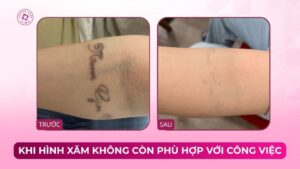 khi hình xăm không còn phù hợp với công việc