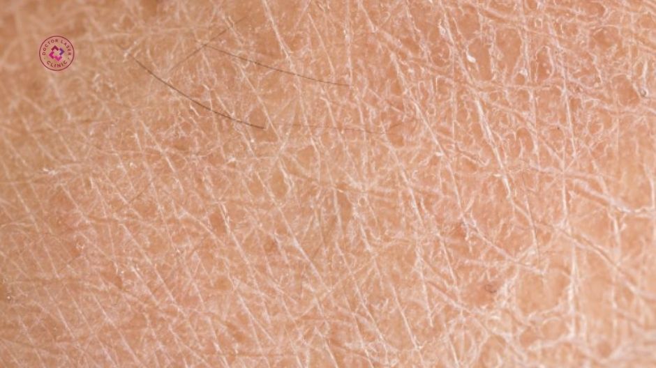 khô da sắc tố có chữa khỏi được không