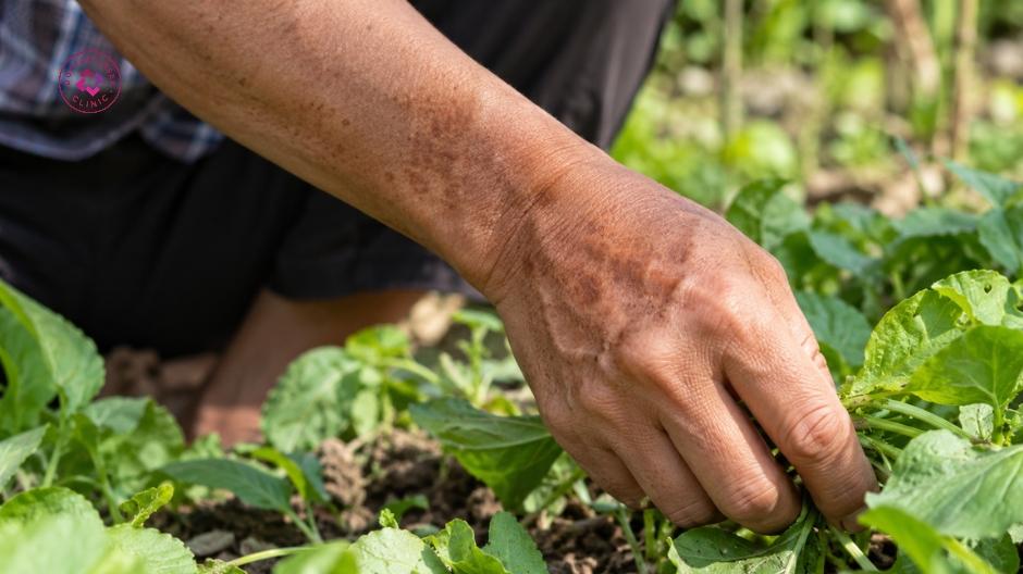 làm việc ngoài trời gây tăng sắc tố da ở tay