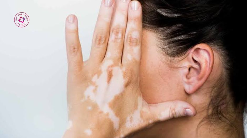 lão hóa da liên quan đến giảm sắc tố dạng giọt