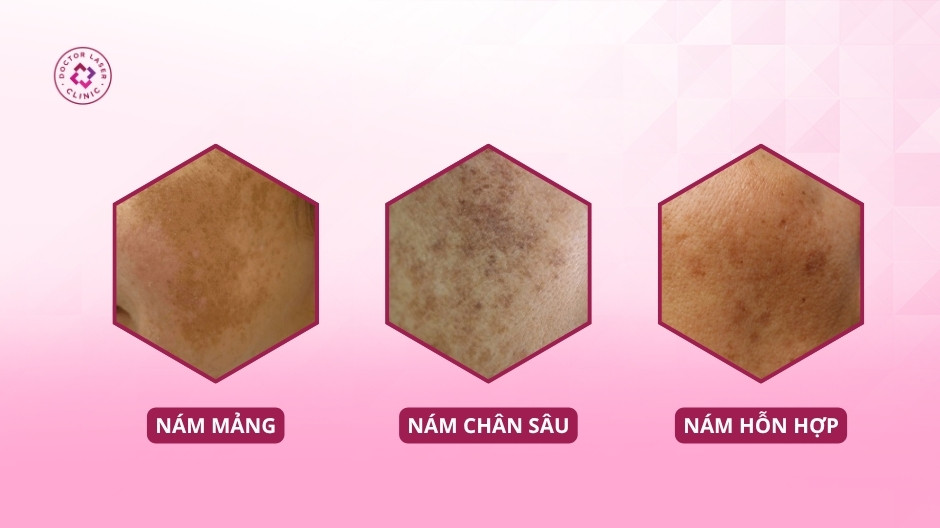 loại nám và tình trạng sắc tố