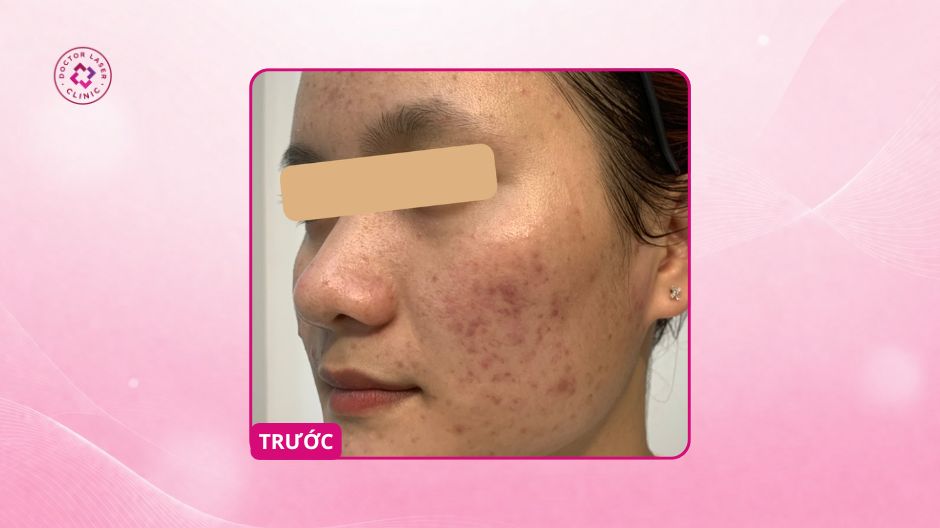 mụn ẩn và thâm sau mụn trước điều trị