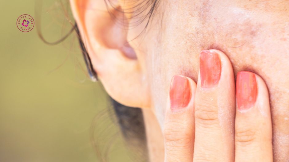 nám da lan rộng sau điều trị