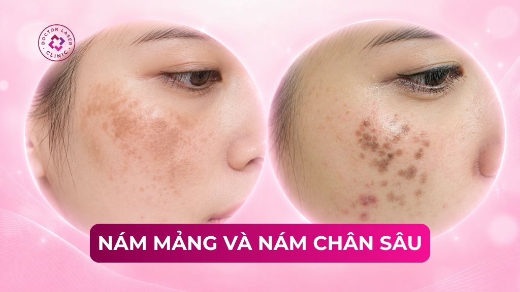 Phân biệt nám mảng và nám chân sâu để điều trị đúng cách