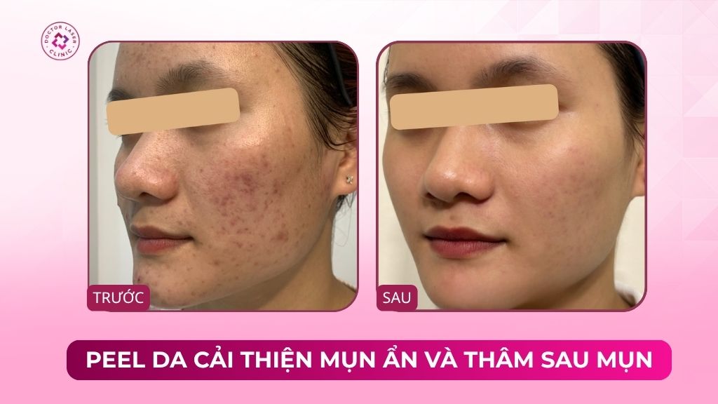 peel da cải thiện mụn ẩn và thâm sau mụn