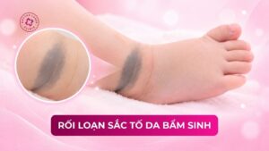 rối loạn sắc tố da bẩm sinh