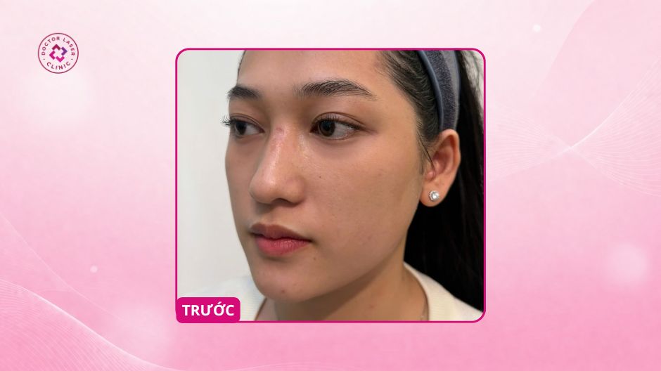 sẹo lõm sống mũi trước điều trị