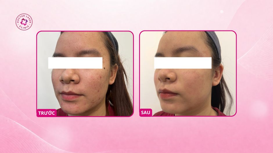 sẹo mụn 7–8 năm sau laser co2 fractional