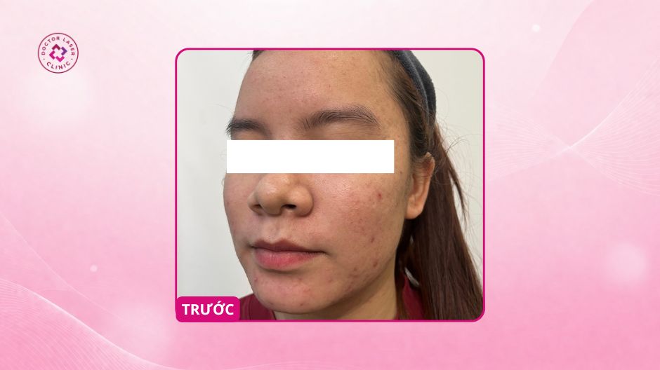 sẹo mụn 7–8 năm trước điều trị