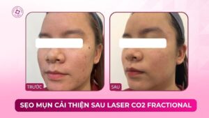 sẹo mụn cải thiện sau laser co2 fractional sẹo mụn cải thiện sau laser co2 fractional