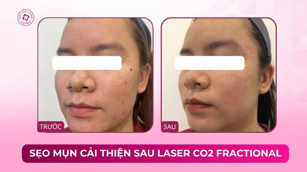 sẹo mụn cải thiện sau laser co2 fractional