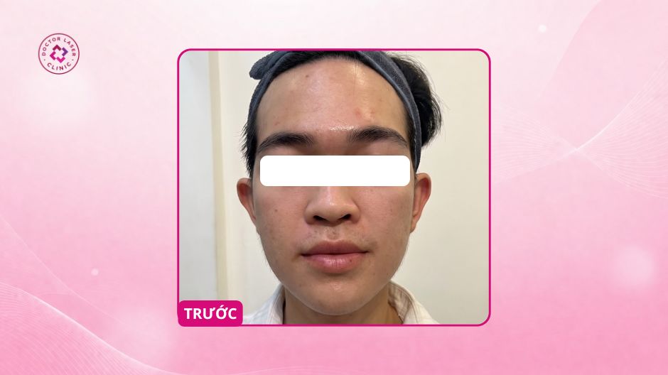 sẹo rỗ lâu năm ở hai bên má và trán do điều trị mụn không đúng cách