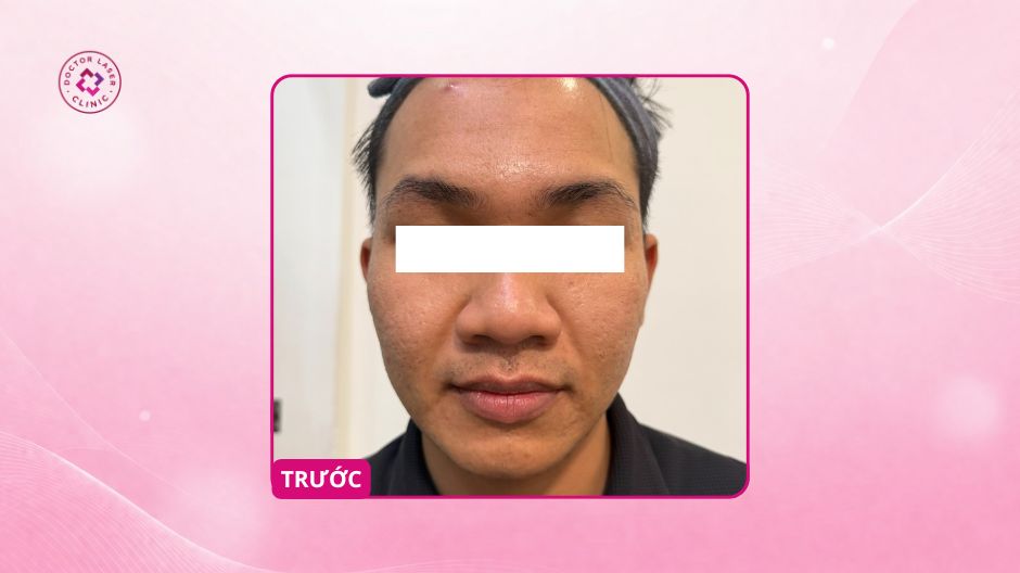 sẹo rỗ lâu năm trước điều trị