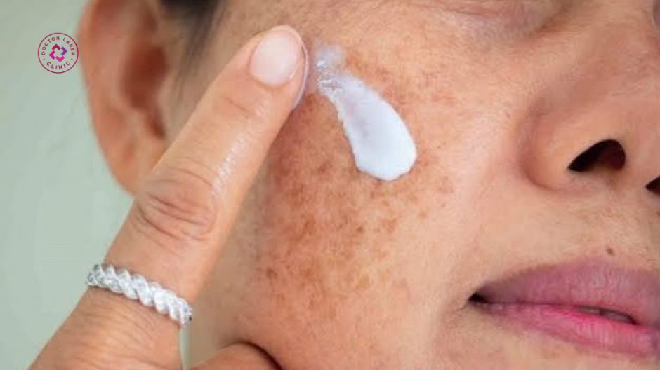 sử dụng mỹ phẩm kém chất lượng khi trị nám