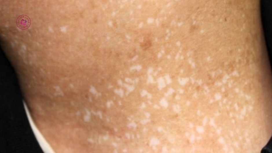 suy giảm enzym tyrosinase gây mất sắc tố da sau laser