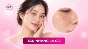 tàn nhang là gì