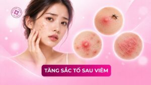 tăng sắc tố sau viêm