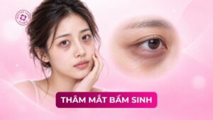 thâm mắt bẩm sinh thâm mắt bẩm sinh